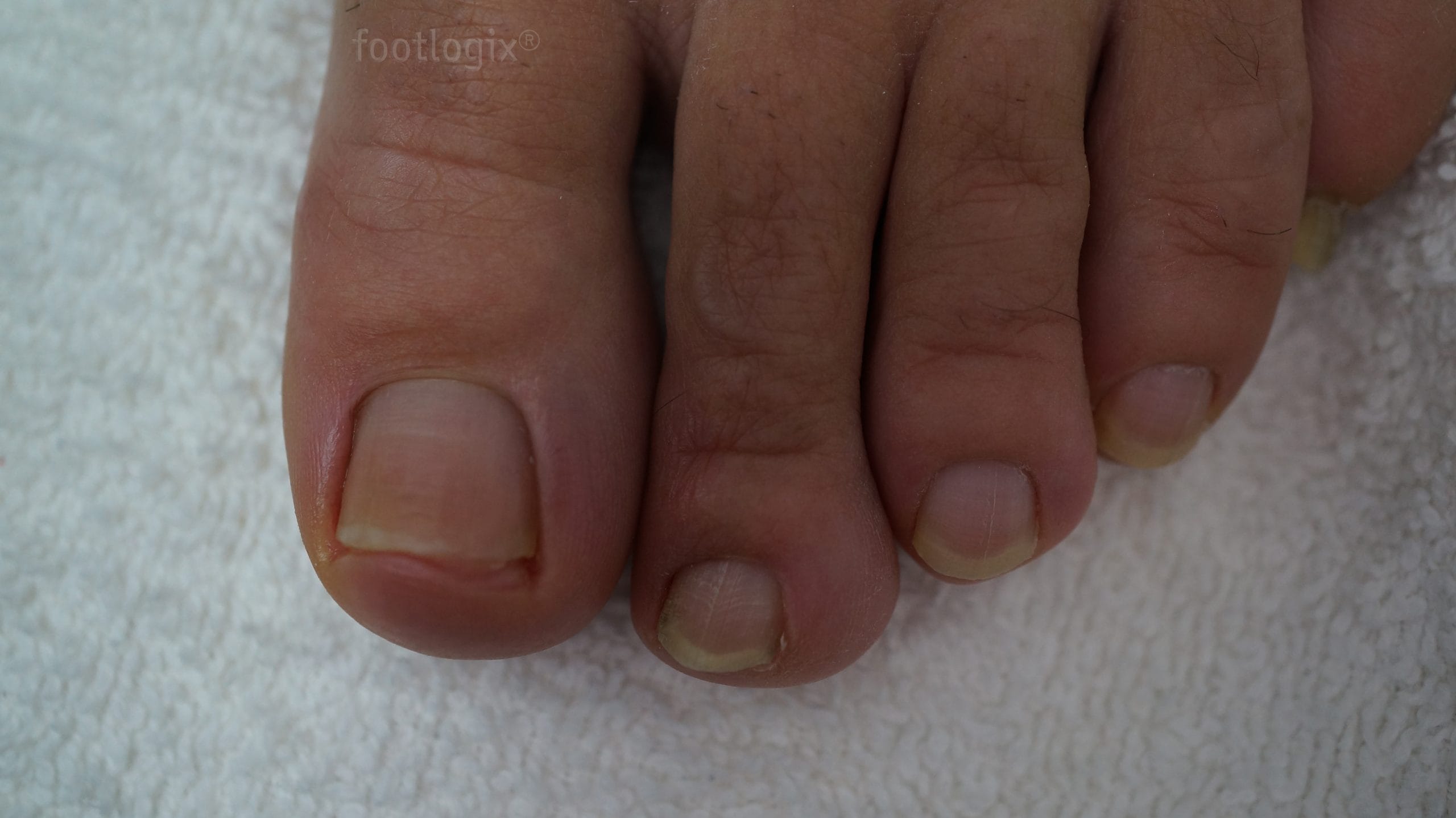 after nail tincture scaled