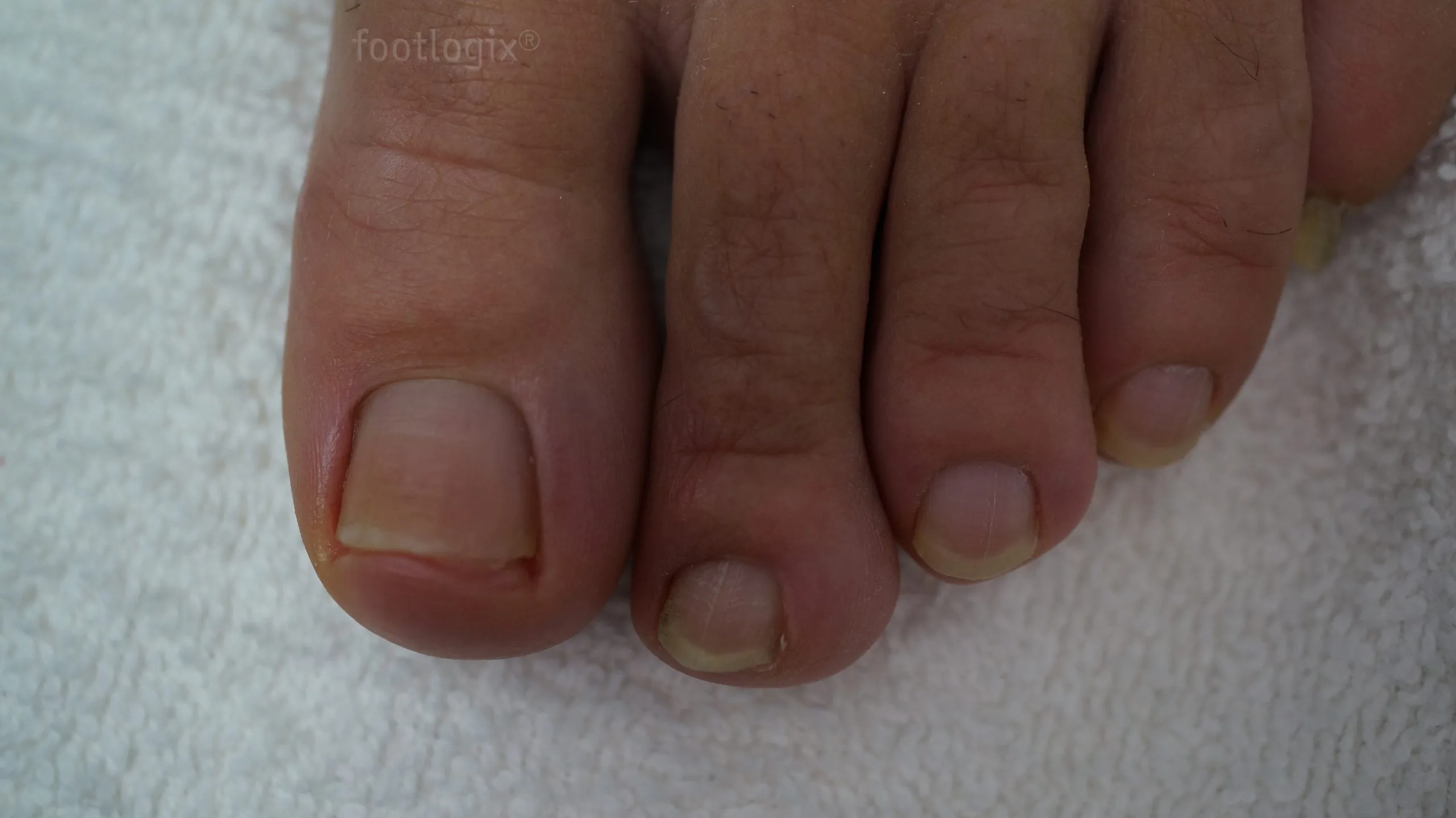 after nail tincture scaled