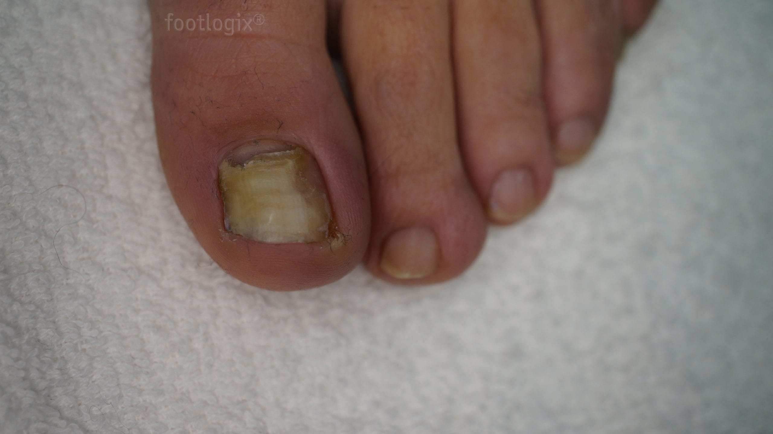 before nail tincture scaled