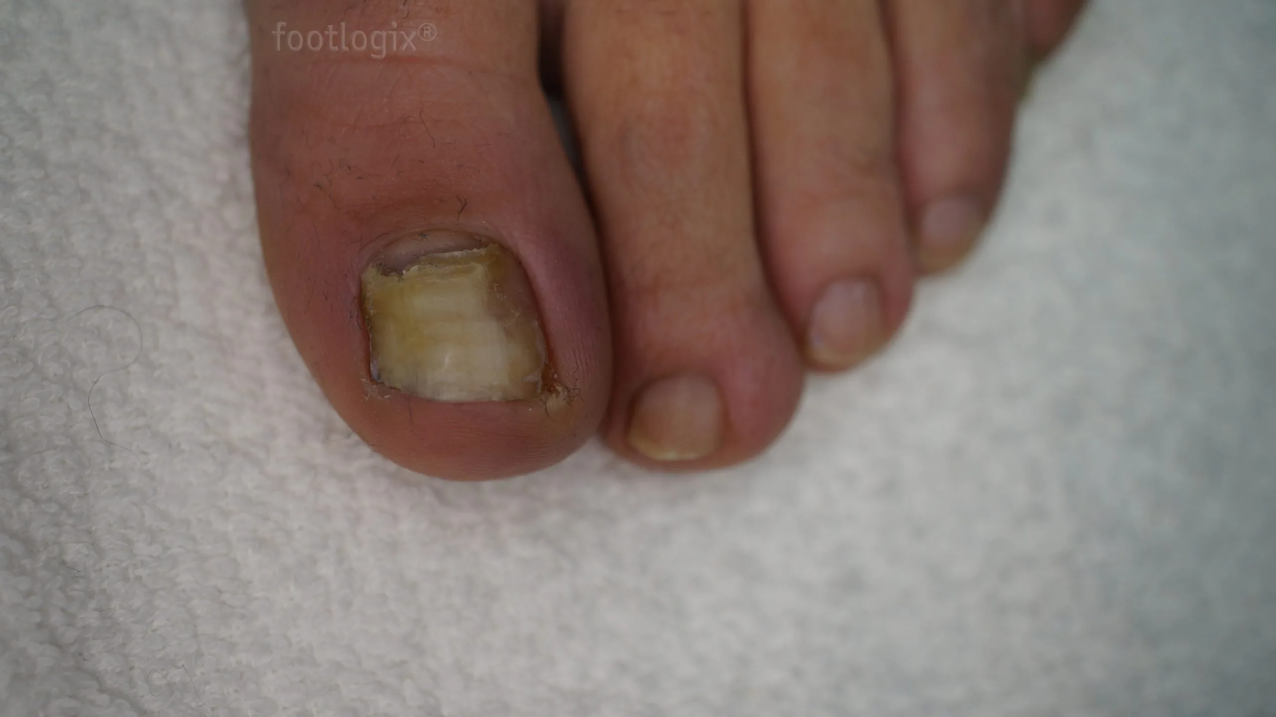 before nail tincture scaled